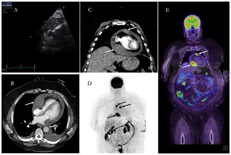 Understanding Cardiac Malignancy: An Uncommon and Intricate Condition