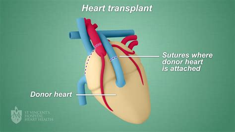 Understanding Cardiac Transplantation: A Life-Enhancing Procedure