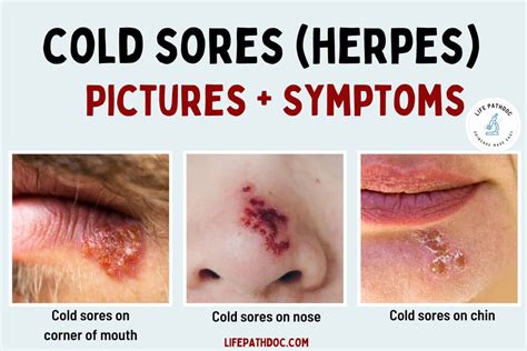 Understanding Cold Sores: What Are They?