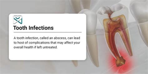 Understanding Dental Infections: What Triggers Them?