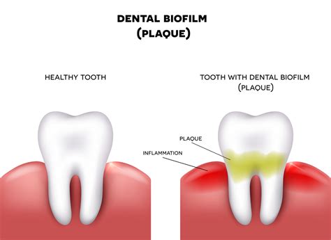 Understanding Dental Plaque and its Impact