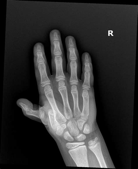 Understanding Dislocated Thumb