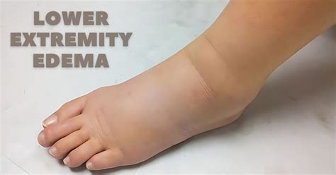 Understanding Edema in the Lower Limb