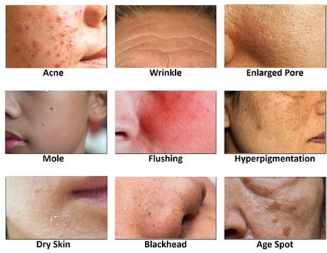 Understanding Face Acne: A Pervasive Skin Condition