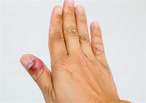 Understanding Finger Infections: A Comprehensive Overview