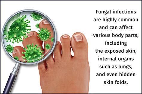 Understanding Fungal Infections: What Causes Fungus Feet?