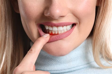 Understanding Gum Bleeding: A Closer Look