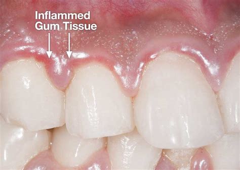 Understanding Inflamed Gum Tissue: A Comprehensive Overview