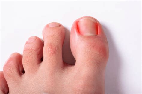 Understanding Ingrown Toenails: An Overview