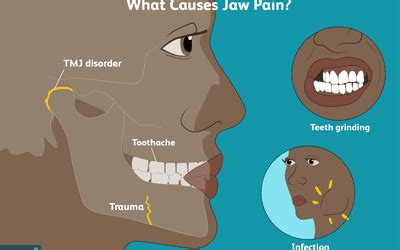 Understanding Locked Jaw: Definition and Overview