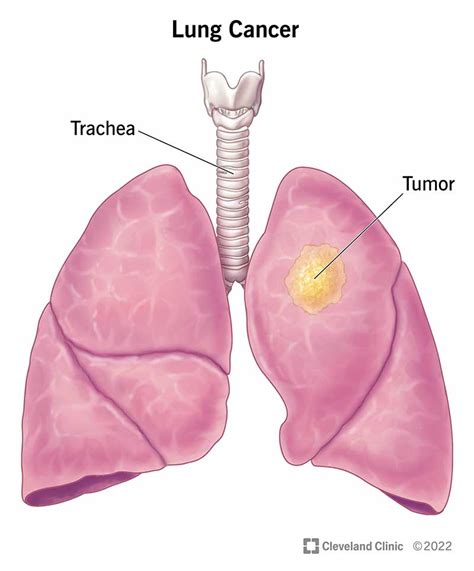 Understanding Lung Cancer: An Overview