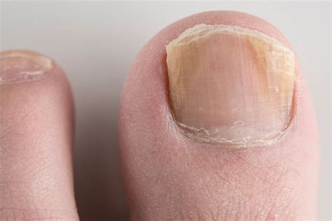 Understanding Nail Fungal Infections: Causes and Symptoms