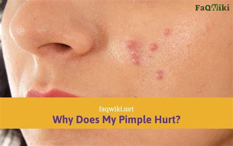 Understanding Pimple: What It Is and Why It Occurs