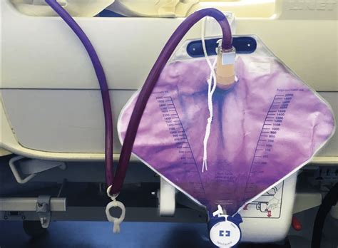 Understanding Purple Urine: An Enigmatic Phenomenon