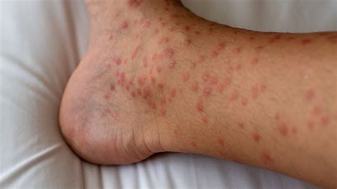 Understanding Skin Hives: What Are They?