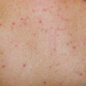 Understanding Skin Rashes: Triggers and Manifestations