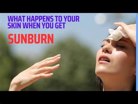 Understanding Sunburn: What Happens to Your Skin?