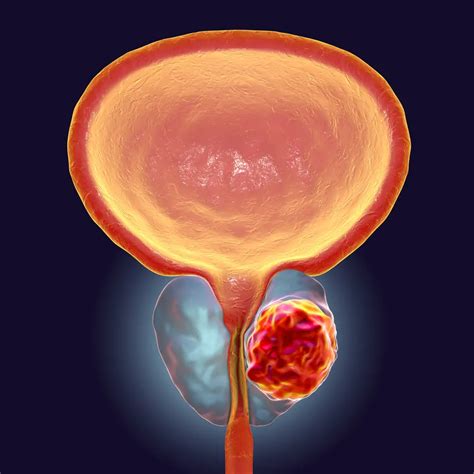 Understanding Swelling in the Testicles: An Insight into the Causes and Occurrence