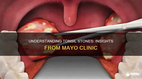 Understanding Tonsil Calculi: A Closer Look