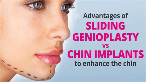 Understanding the Advantages and Disadvantages of Chin Implants