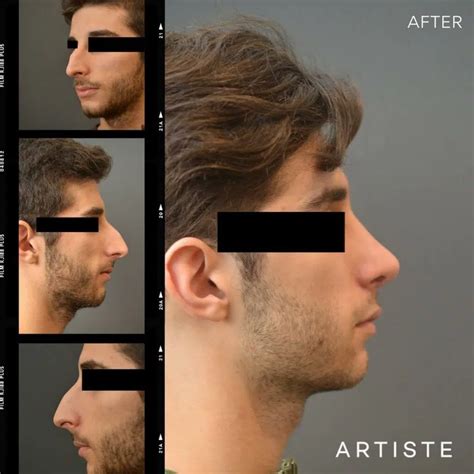 Understanding the Attraction to Rhinoplasty