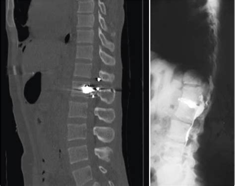 Understanding the Basics of Experiencing Multiple Gunshot Wounds in the Spine