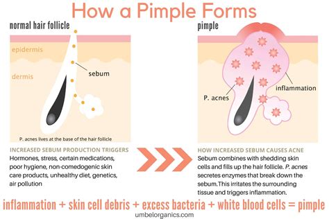 Understanding the Biological Mechanisms Behind Pimple Formation