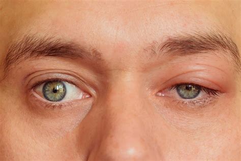 Understanding the Causes and Risks of Eye Swelling