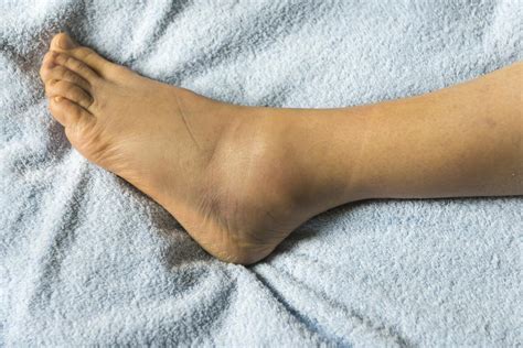 Understanding the Causes and Solutions for Foot Swelling