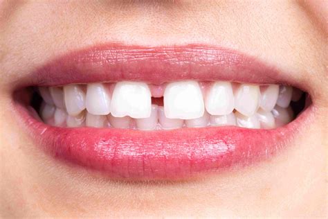 Understanding the Causes and Types of Teeth Gaps