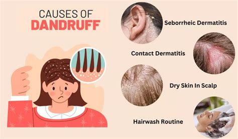 Understanding the Causes of Dandruff