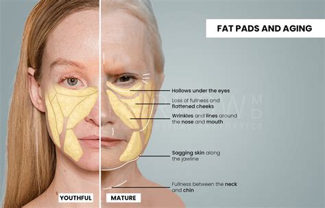 Understanding the Causes of Excess Facial Fat and its Impact on Your Facial Structure