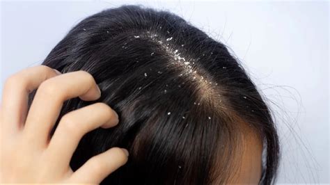 Understanding the Causes of Excessive Scalp Flakes and Strategies to Combat Them