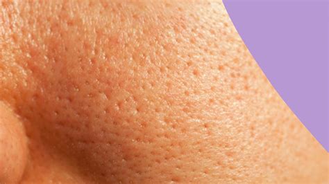 Understanding the Causes of Massive Clogged Pores