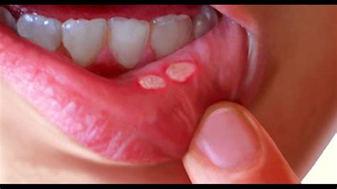 Understanding the Experience of Having an Ulcer in the Oral Cavity