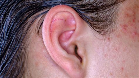 Understanding the Factors Behind the Formation of Ear Pimples