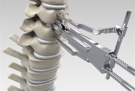 Understanding the Fundamentals of Spinal Procedures