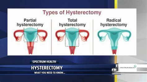 Understanding the Fundamentals of a Hysterectomy