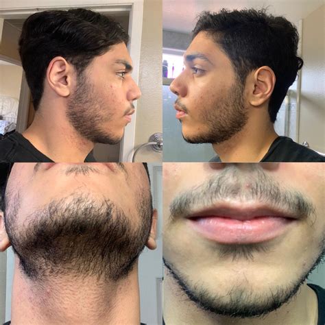 Understanding the Growth of Facial Hair