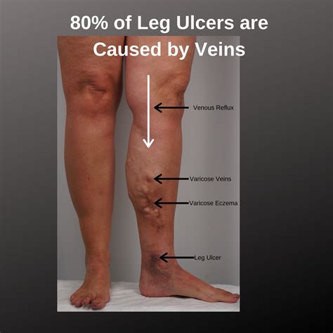 Understanding the Impact of Leg Ulcers