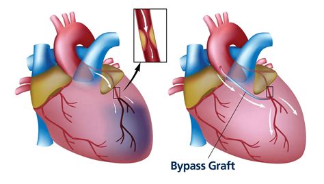 Understanding the Importance of a Cardiac Graft