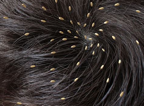 Understanding the Issue: Fundamentals of Head Lice Infestation