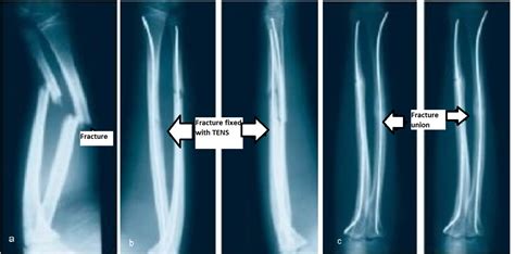 Understanding the Nature of Fractured Nails: A Comprehensive Overview