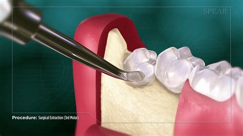 Understanding the Necessity of Extracting Third Molars