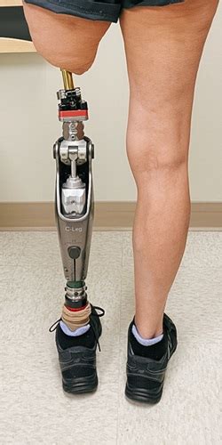 Understanding the Need for Advanced Limb Restoration