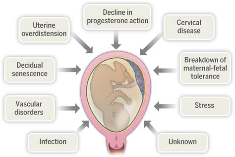 Understanding the Onset of Premature Delivery