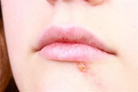 Understanding the Origins, Indications, and Avoidance of Lip Herpes