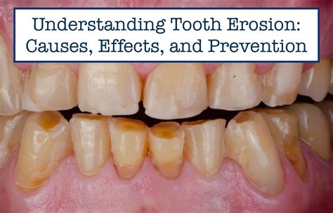 Understanding the Origins: Common Causes of Dental Erosion