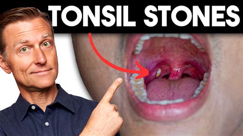 Understanding the Origins of Enlarged Tonsils: Uncovering the Root Causes