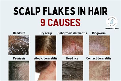 Understanding the Origins of Persistent Scalp Flakes